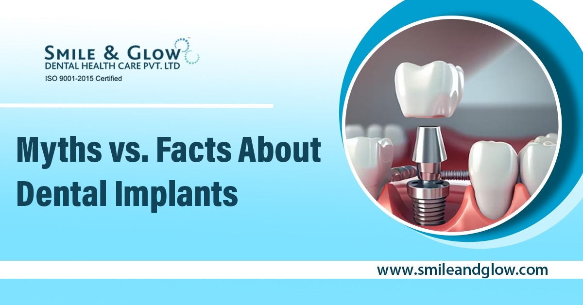 myths-vs-facts-about-dental-implants